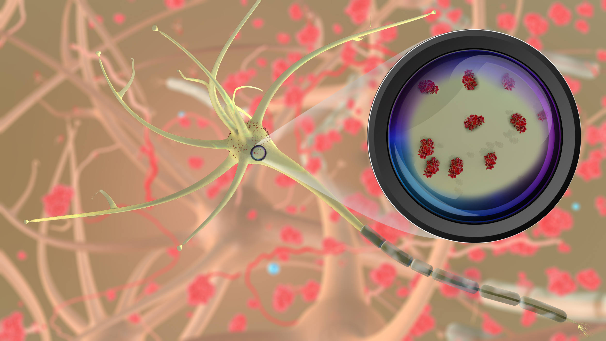 Prion disease